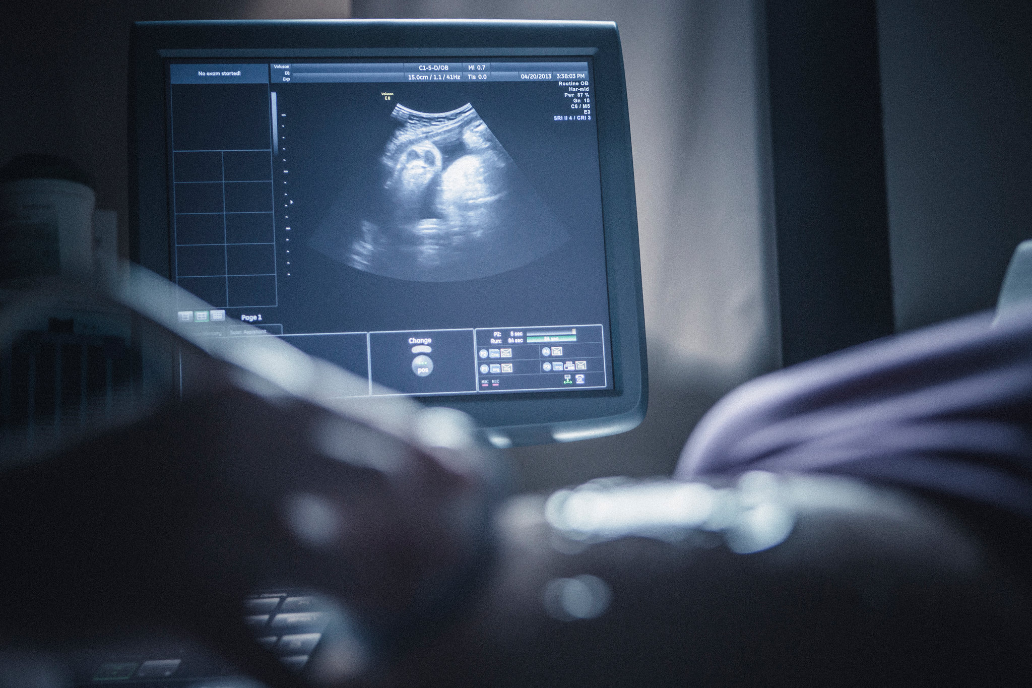  سونوگرافی غربالگری اول| Ultrasound screening first