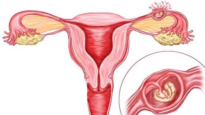 endometriosis/اندومتریوز