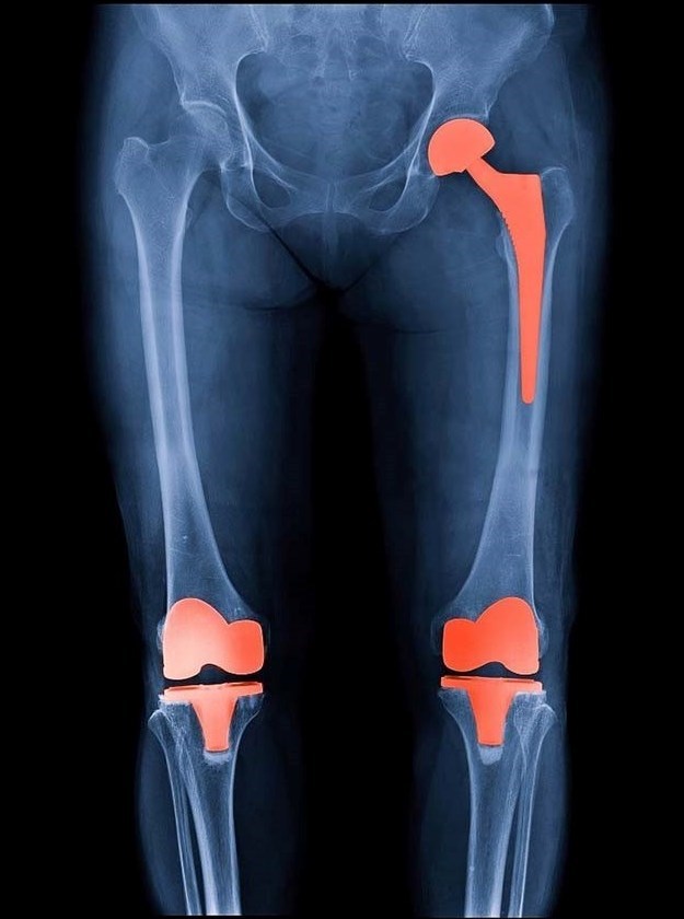 s/عکس از ۳ مفصل ران و زانو و مچ پا