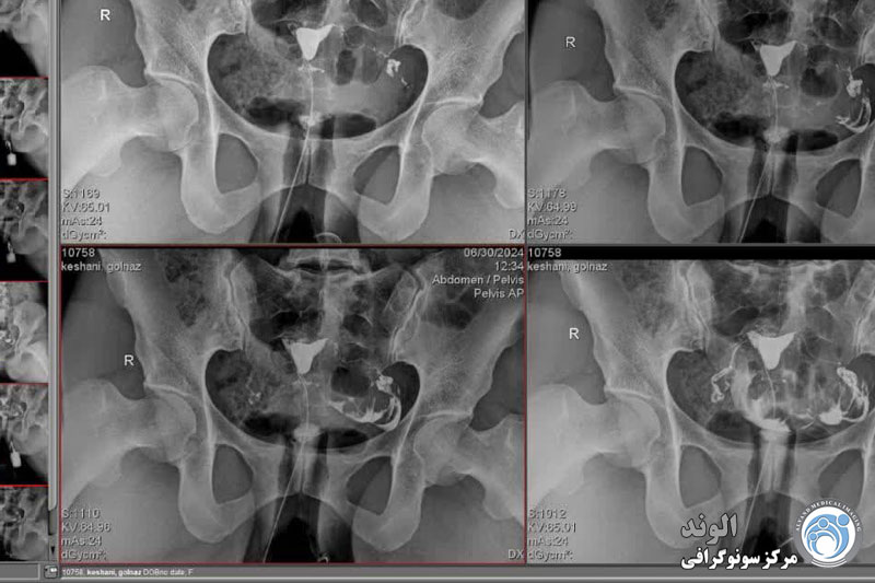 هیستروسالپنگوگرافی