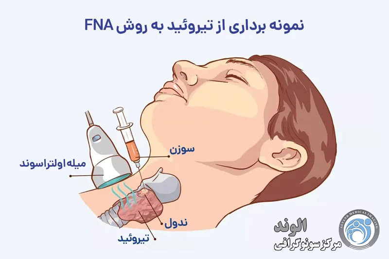 f/FNA بیوپسی از تیروئید