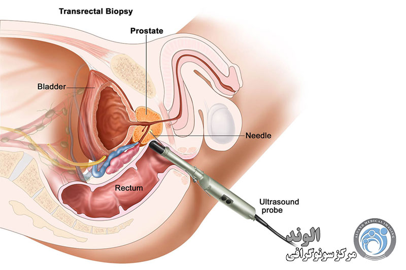 s/بیوپسی پروستات