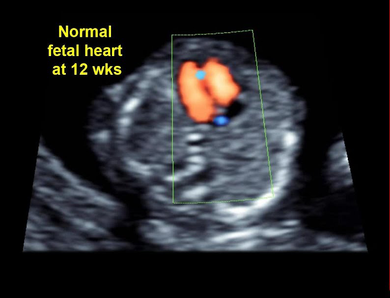 e/اکوی قلب جنین