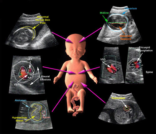 k/اکوکاردیوگرافی جنین ( اکوی قلب جنین )