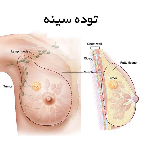 d/عفونت پستان یا ماستیت چیست؟