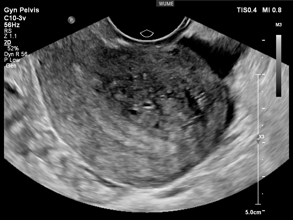 The best time for a vaginal ultrasound/بهترین زمان برای سونوگرافی واژینال